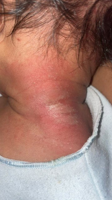 ruam pada leher bayi