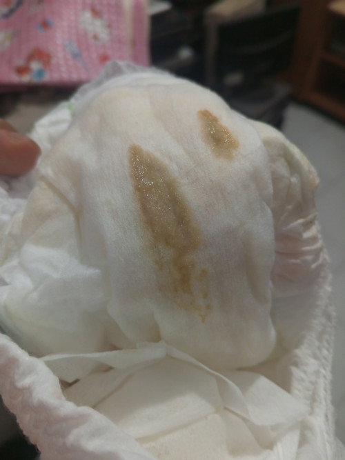 Bayi 3,5 bln pipis sedikit