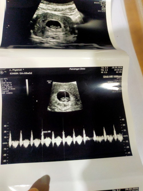 อายุครรภ์8week หัวใจเบบี๋เต้นผิดจังหวะ