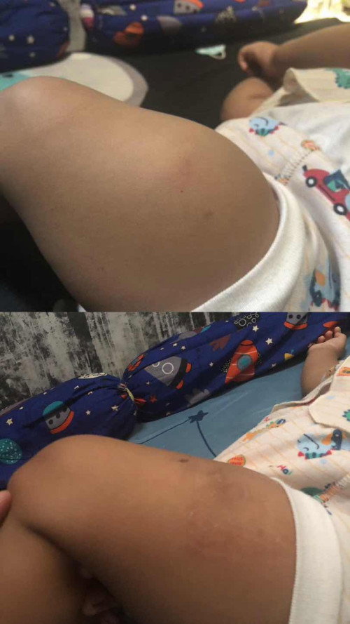 Trauma imunisasi