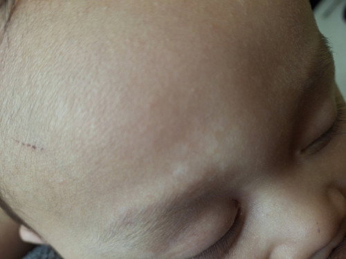 Putih² di kulit wajah bayi