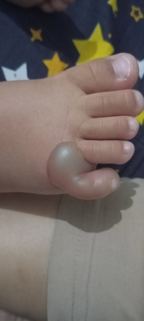 kaki bayi bengkak