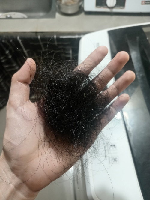 Hair loss, baka may alam po kayong solusyon mga mii.