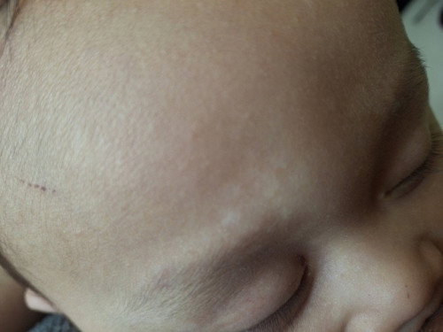 Putih² di kulit wajah bayi