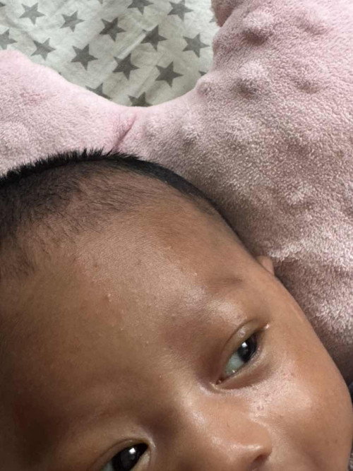 Ruam kecik di muka baby