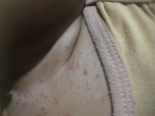Bintik merah pada bayi usia 4blan lebih