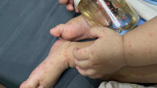 Rashes? Hmfd?