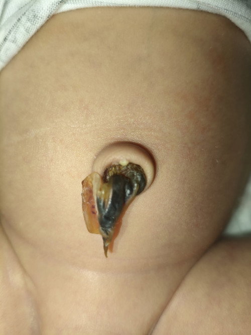 May bilog na puti SA base Ng pusod ni baby