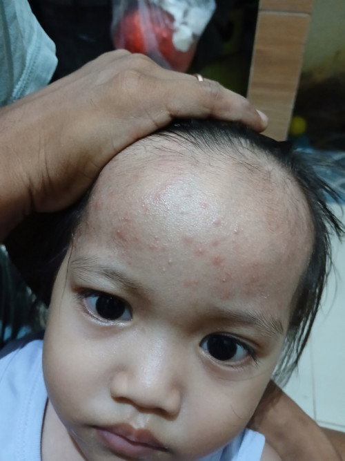 Bintik di kening dan kepala