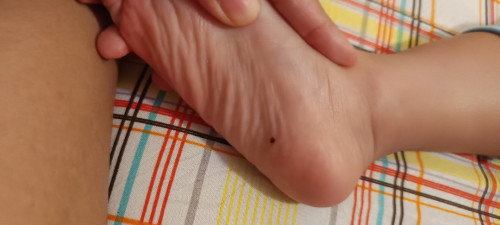 Bintik coklat hitam di telapak kaki