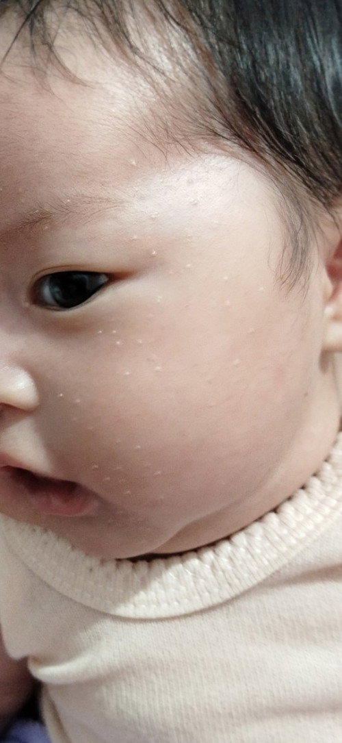 Milia bawaan lahir