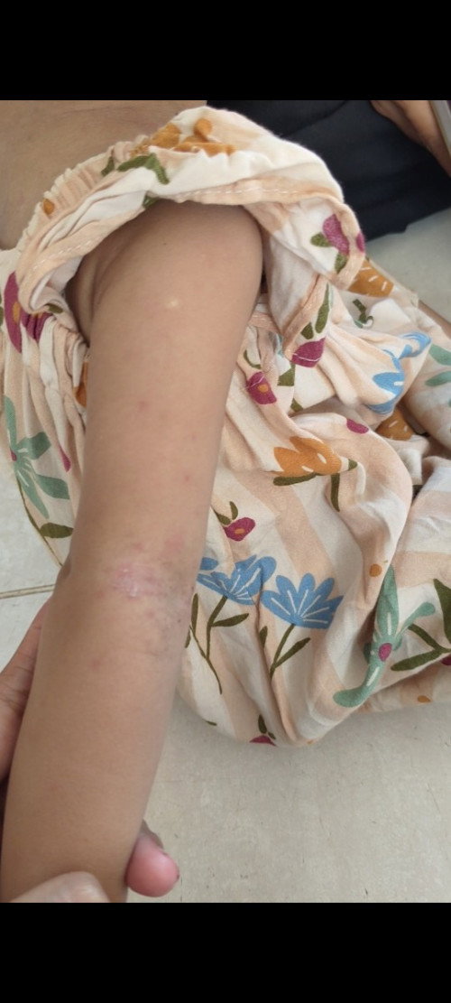 biang keringet pada anak 1 tahun