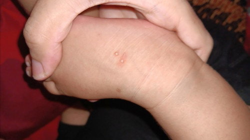 Bintik air yang hilang timbul bayi 4bulan