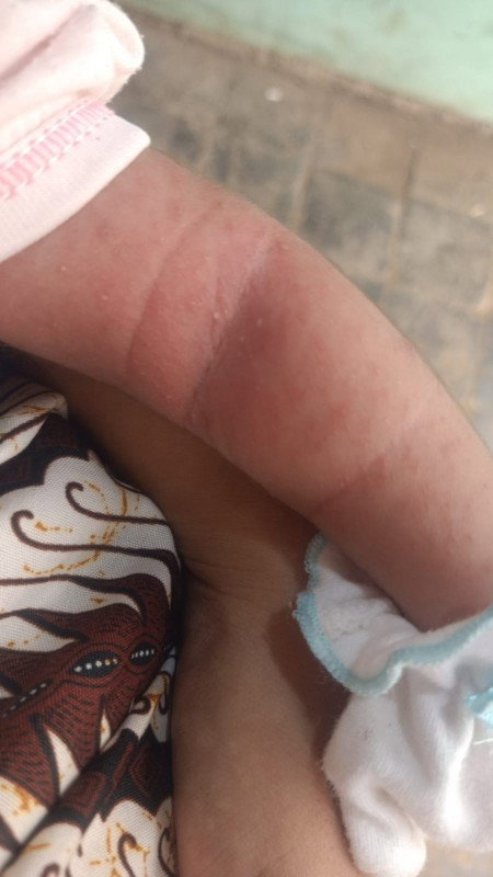 Bintik" merah pd bayi 20hari