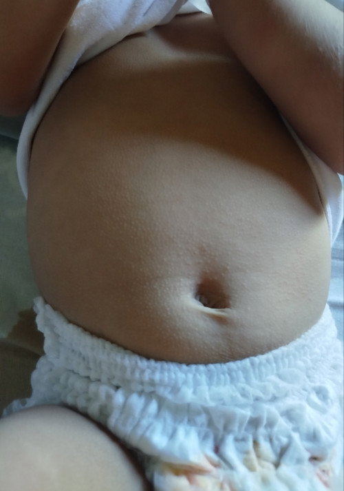 Rashes sa skin ni baby