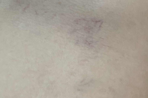 Pembuluh darah timbul / stretchmark ?