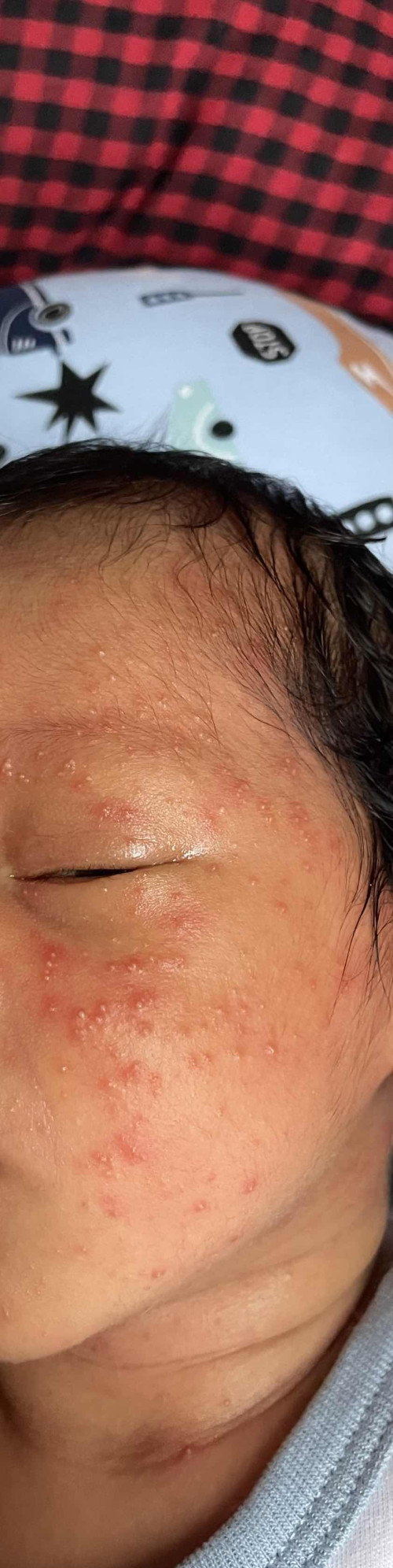 Muka merah bintik seperti jerawat