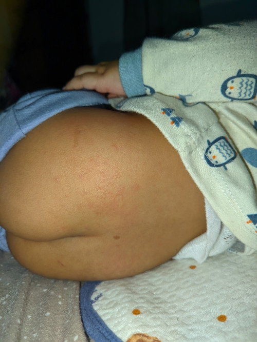 Gatal di area bokong dan bentol di area kaki