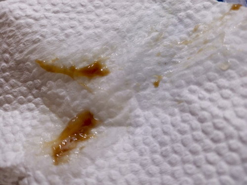 Is this Mucus plug dangerous for 21 weeks pregnant? Mag preterm ba ako soon? 🥲