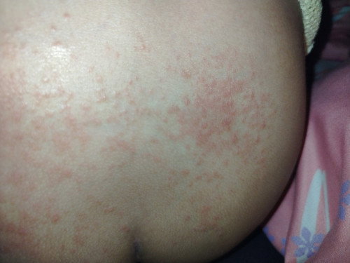 rash cream