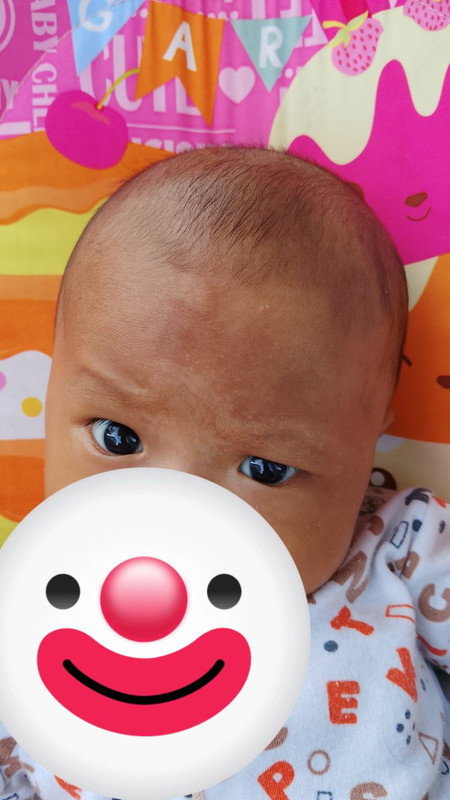 Bercak putih pada bayi