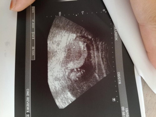11w6d tapi ad fibroid