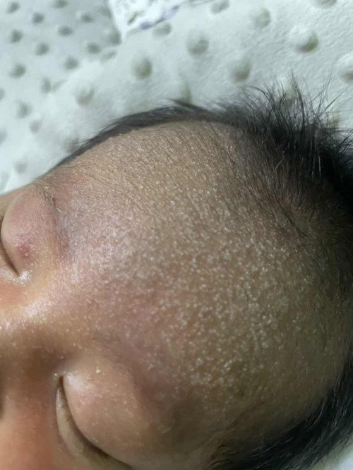 Kepala baby ada ruam
