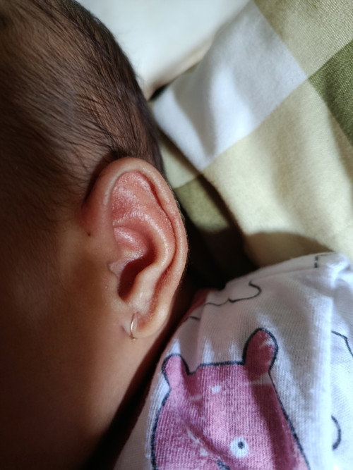 Bintik-bintik kecil pada telinga bayi