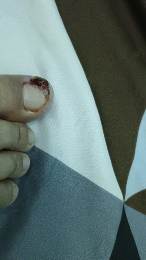 Cantengan kuku kaki
