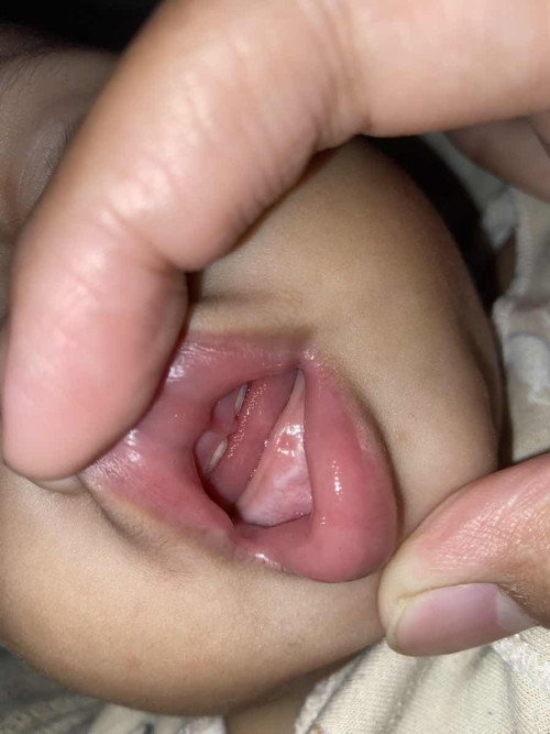 Bayi 11 Bulan Tumbuh Gigi