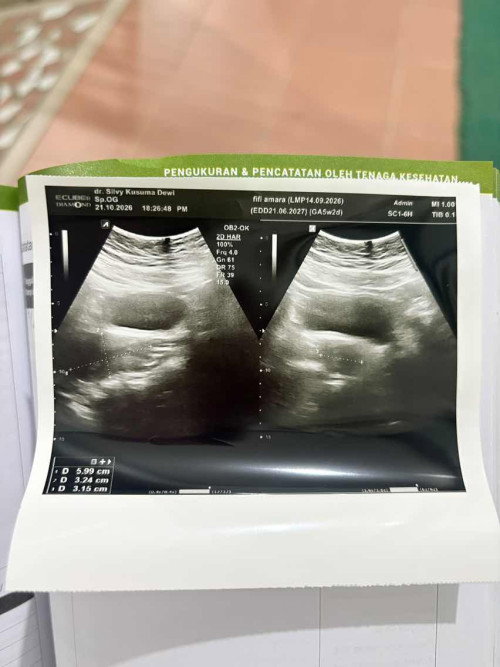 5minggu saat usg belum kelihatan apapun
