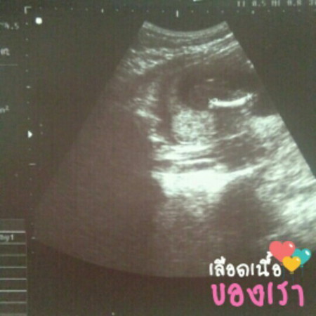 ภาพซาวน์ลูก18week2day