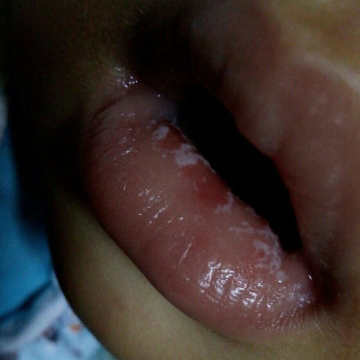 bibir bercak putih