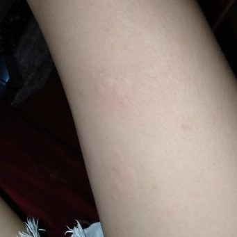 alergi atau apa ya Bun ?