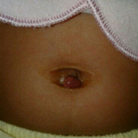 pusar bayi basah & bentol