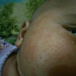 Sering Di Cium Pipi Merah Iritasi