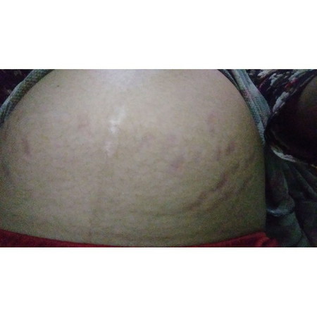 Stretch Marks