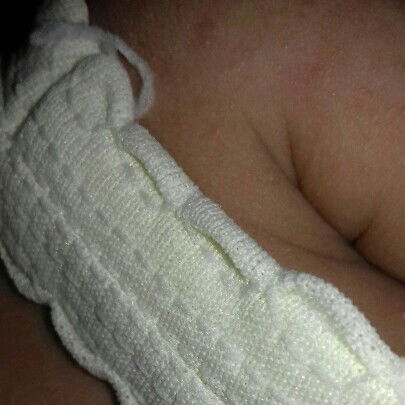 biang keringat pada bayi 3 bulan