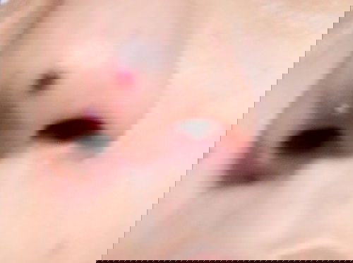 Pimple? or Mamaso sa ilong...