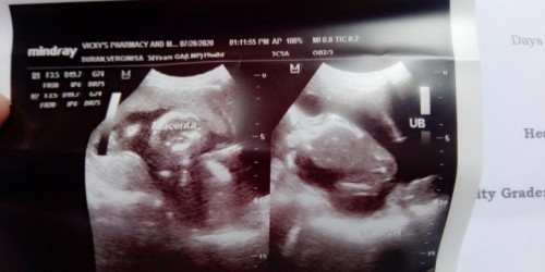 this is my ultrasound