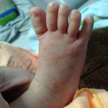 ลูกแพ้อะไร