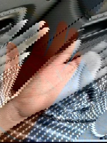 อาการเท้าบวมมือบวม 33w3d