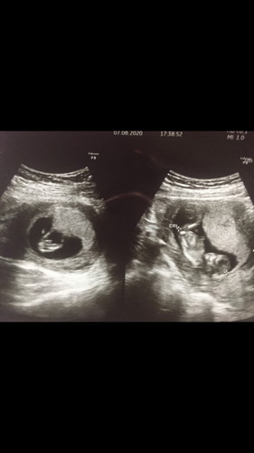 12W4D
