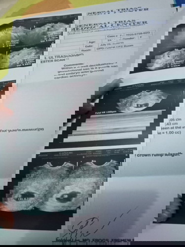 Subchorionic hemorrhage πͺπ