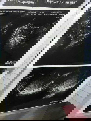 Telat haid 1minggu tapi di usg masih belum terlihat , kapan akan terlihat ya ? Baiknya usg kapan ?