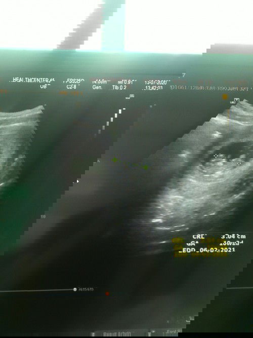 สอบถามค่ะ ท้องเเรก