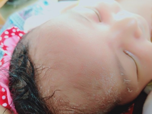 bun kalo bayi umur 7 hari bruntusan pke apa obat ny