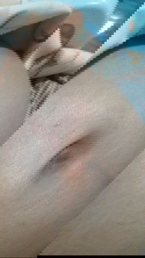 คันรอบสะดือ