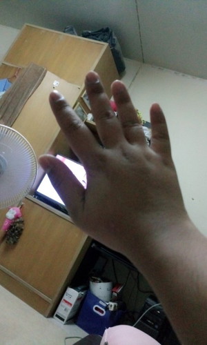 มือบวม, ปวด