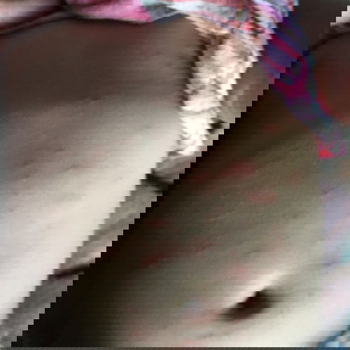 น้องแพ้นมวัวหรือปล่าว ?